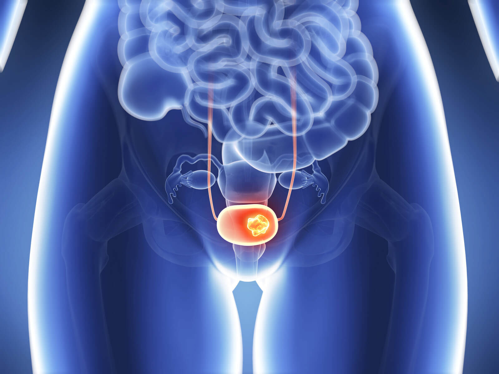 Câncer de Bexiga, Ureter e Adrenal - Dr. Bruno Passos