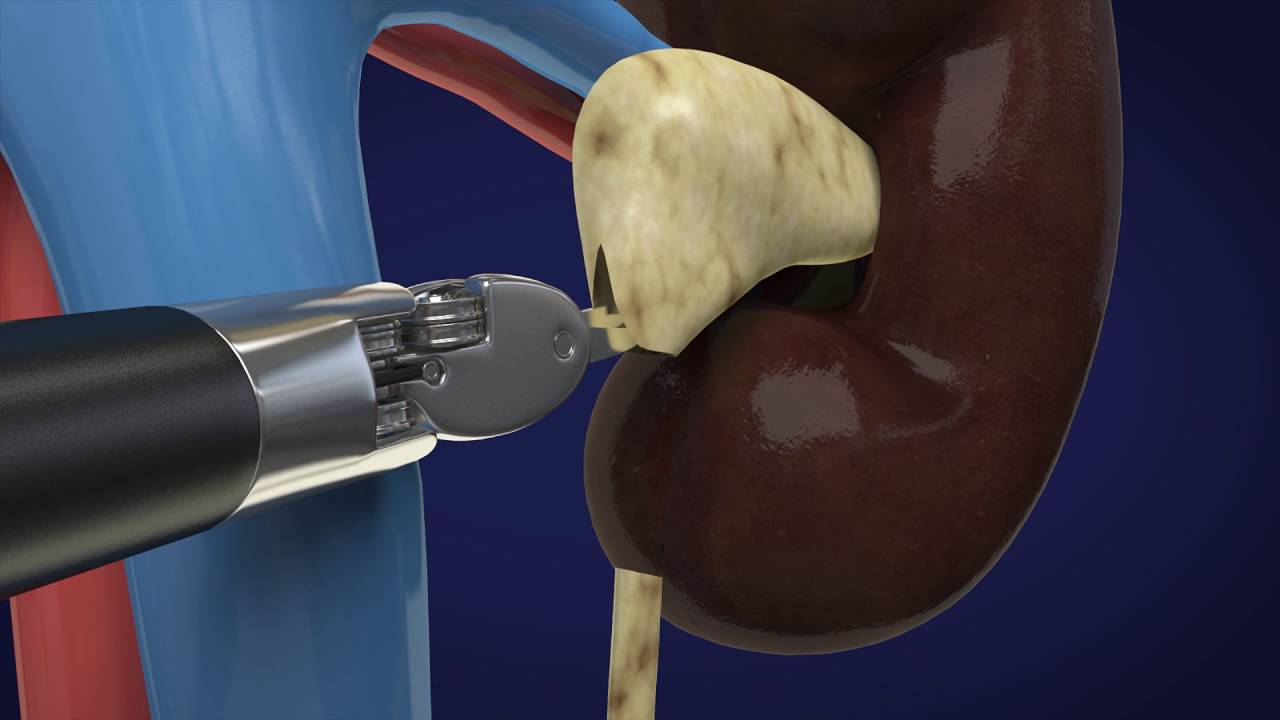 Estenose de JUP e Cirurgias Reconstrutoras do Ureter - Dr. Bruno Passos