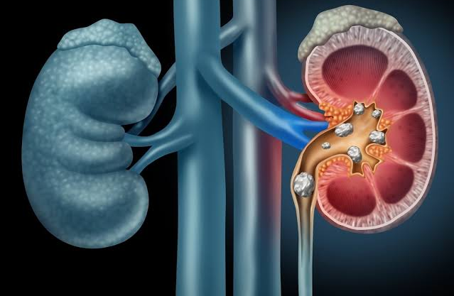 Cálculo Renal - Dr. Bruno Passos